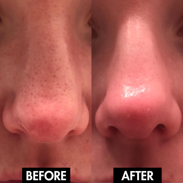 PureGlow Pore Vacuum™